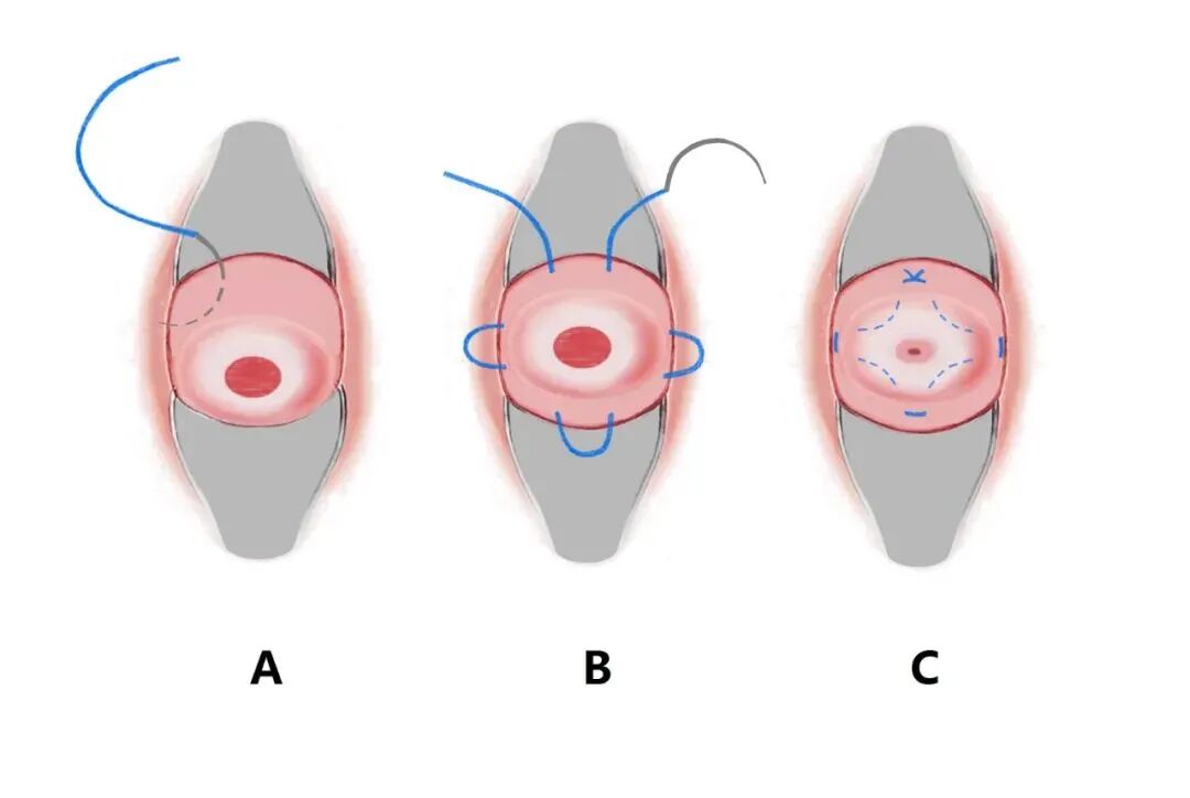 子宫拉钩怎么用经阴道宫颈环扎术保姆级教学：4大术式分步骤带图讲解，值得收藏！_https://www.jmylbn.com_新闻资讯_第8张