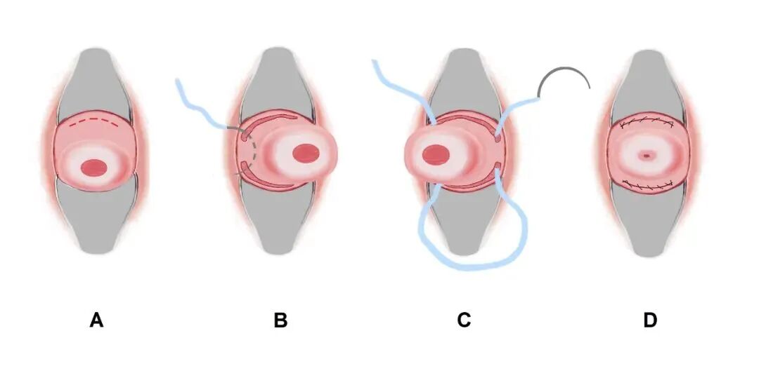 子宫拉钩怎么用经阴道宫颈环扎术保姆级教学：4大术式分步骤带图讲解，值得收藏！_https://www.jmylbn.com_新闻资讯_第4张