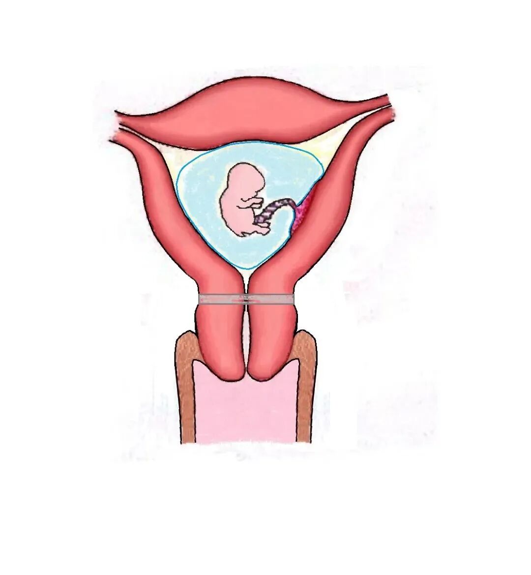 子宫拉钩怎么用经阴道宫颈环扎术保姆级教学：4大术式分步骤带图讲解，值得收藏！_https://www.jmylbn.com_新闻资讯_第3张
