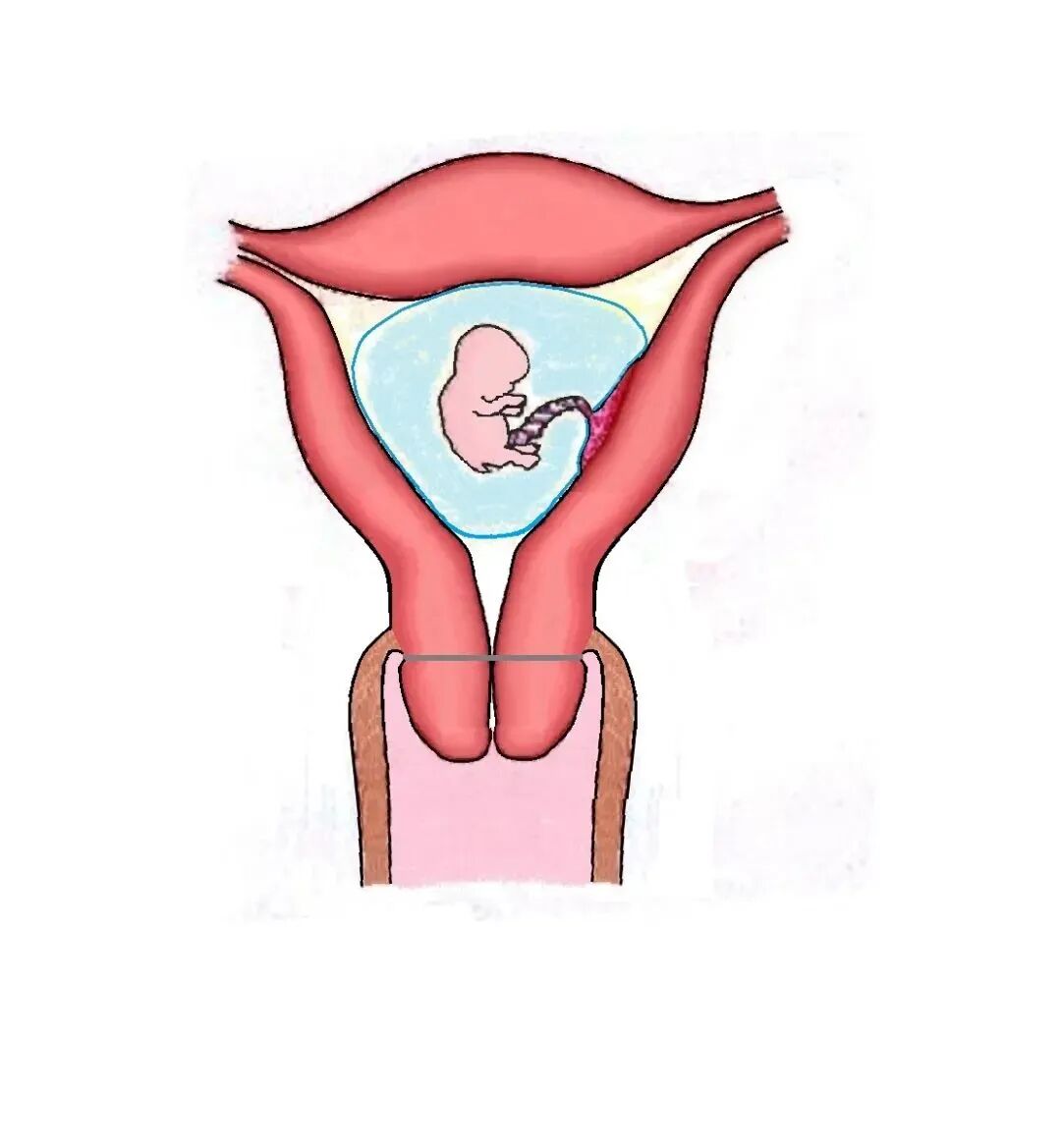 子宫拉钩怎么用经阴道宫颈环扎术保姆级教学：4大术式分步骤带图讲解，值得收藏！_https://www.jmylbn.com_新闻资讯_第7张