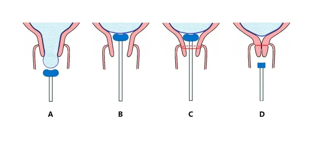 子宫拉钩怎么用经阴道宫颈环扎术保姆级教学：4大术式分步骤带图讲解，值得收藏！_https://www.jmylbn.com_新闻资讯_第12张