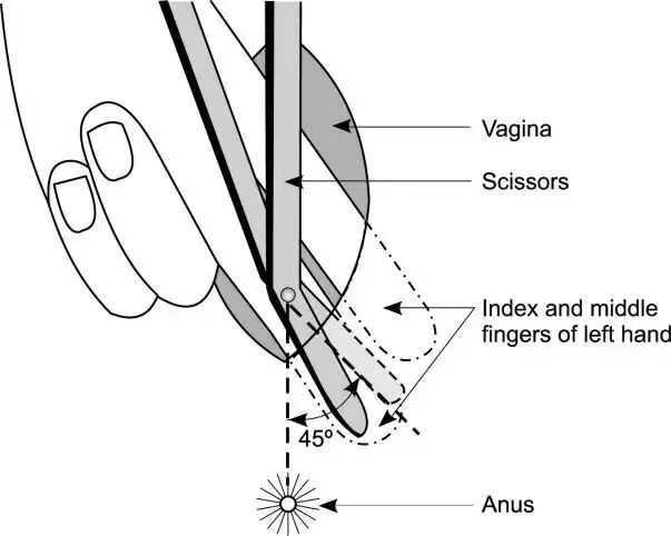 kielland产钳怎么翻译分步骤讲解低位产钳术，一文全部掌握！（内有福利）_https://www.jmylbn.com_新闻资讯_第7张