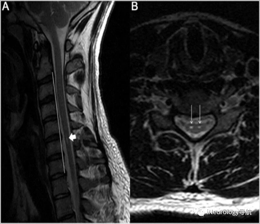 Neurology病例 平山病的前角细胞高信号 Ineurology导航 微信公众号文章阅读 Wemp