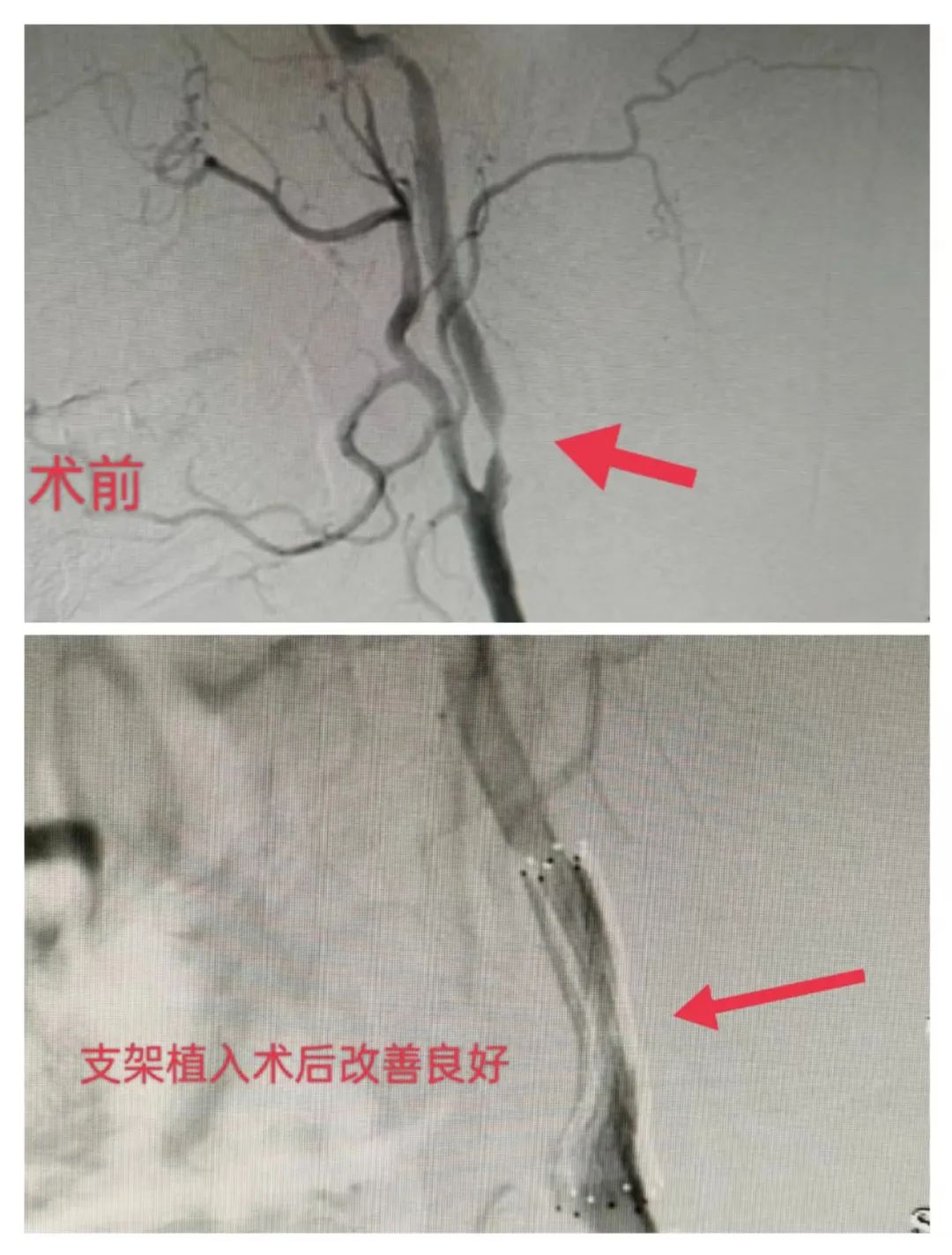 脑血管支架手术过程图片