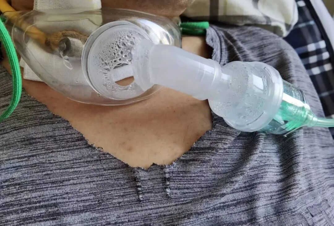 气管切开状态,留置胃管,四肢全部瘫痪,心率忽快忽慢