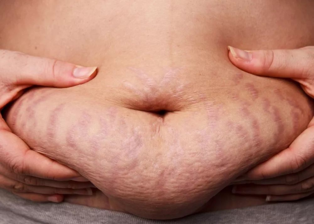 懷孕紋、松肚皮能修復嗎？看看這篇文章吧！ 親子 第3張