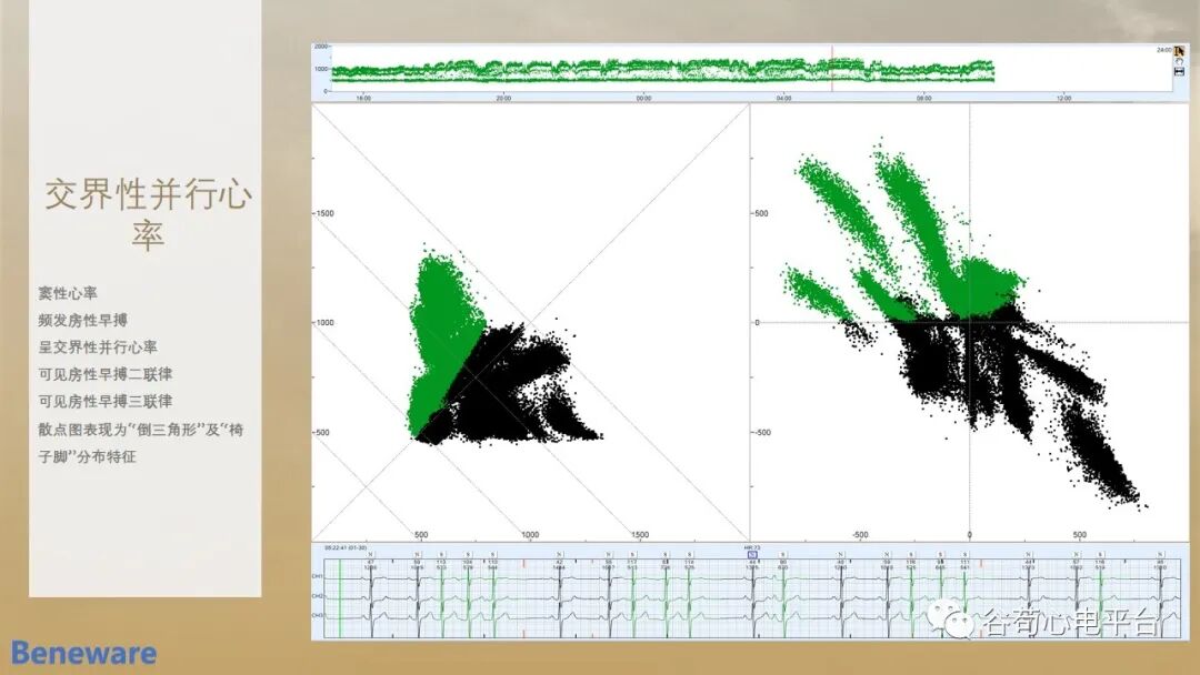 动态心电图怎么分析动态心电图分析心律失常的价值_https://www.jmylbn.com_新闻资讯_第9张