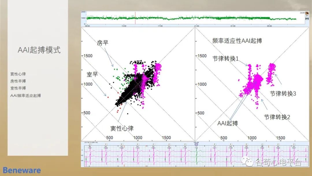 动态心电图怎么分析动态心电图分析心律失常的价值_https://www.jmylbn.com_新闻资讯_第7张