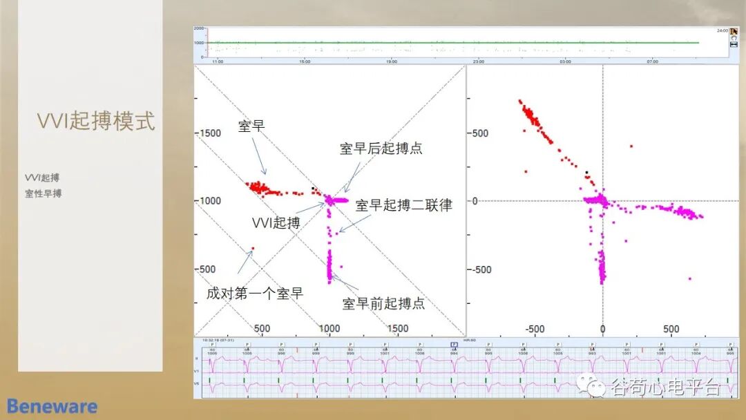 动态心电图怎么分析动态心电图分析心律失常的价值_https://www.jmylbn.com_新闻资讯_第6张
