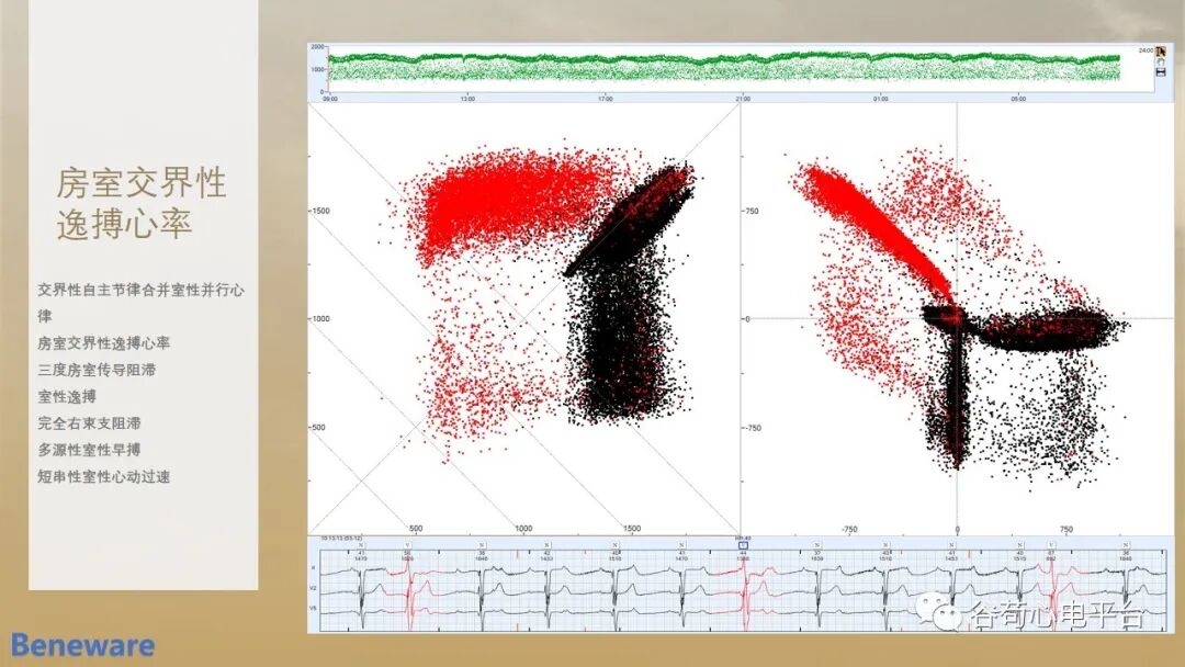 动态心电图怎么分析动态心电图分析心律失常的价值_https://www.jmylbn.com_新闻资讯_第11张