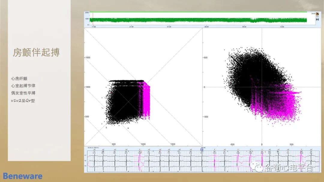 动态心电图怎么分析动态心电图分析心律失常的价值_https://www.jmylbn.com_新闻资讯_第8张