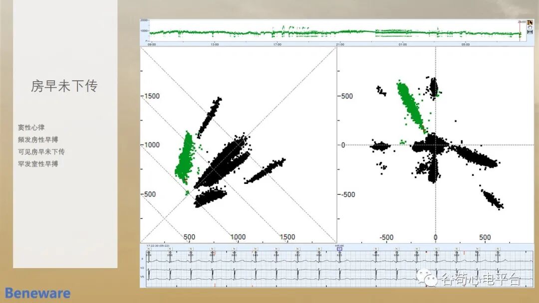 动态心电图怎么分析动态心电图分析心律失常的价值_https://www.jmylbn.com_新闻资讯_第12张