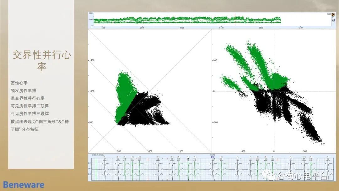 动态心电图系统怎么用如何阅读24小时动态心电图？这篇一定要收藏！_https://www.jmylbn.com_新闻资讯_第15张
