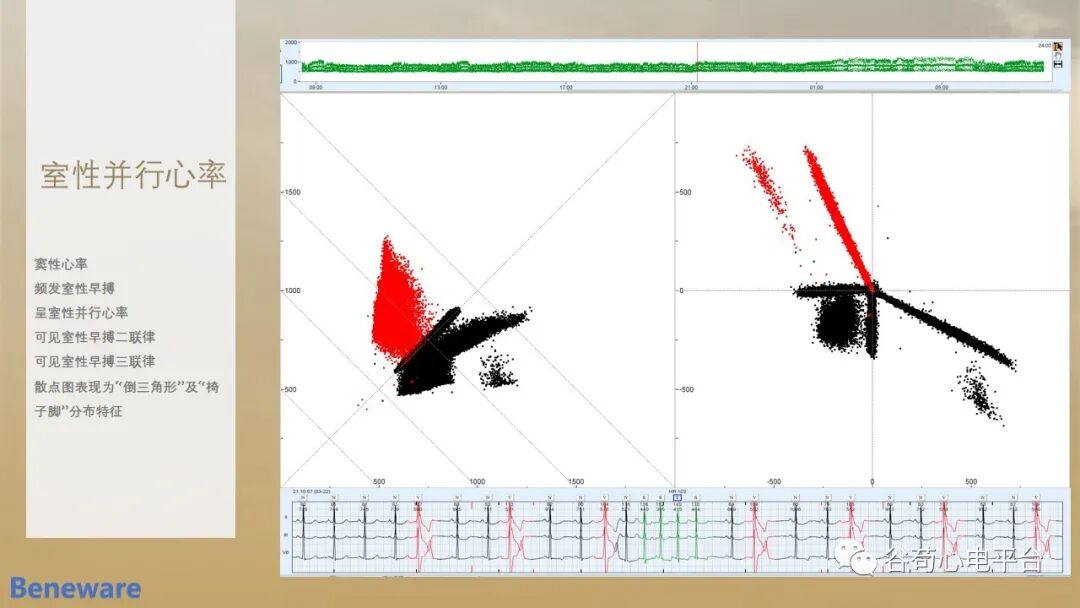 动态心电图系统怎么用如何阅读24小时动态心电图？这篇一定要收藏！_https://www.jmylbn.com_新闻资讯_第16张