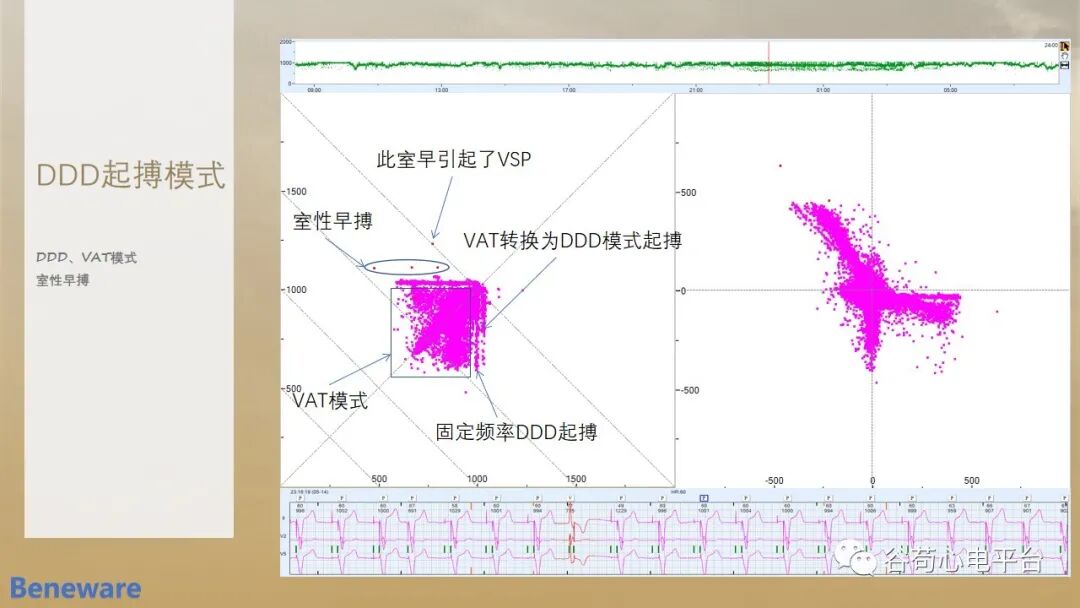 动态心电图系统怎么用如何阅读24小时动态心电图？这篇一定要收藏！_https://www.jmylbn.com_新闻资讯_第11张