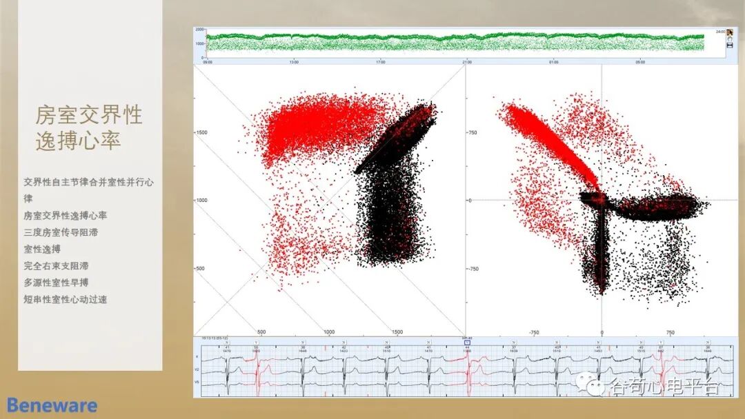 动态心电图系统怎么用如何阅读24小时动态心电图？这篇一定要收藏！_https://www.jmylbn.com_新闻资讯_第17张