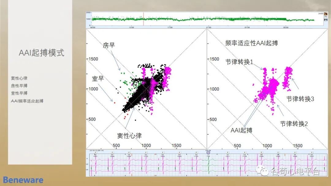 动态心电图系统怎么用如何阅读24小时动态心电图？这篇一定要收藏！_https://www.jmylbn.com_新闻资讯_第13张