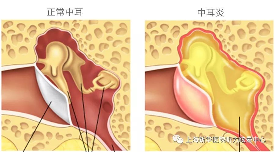 「儿童听力专栏」宝宝的耳朵出现各种问题,听力下降了,怎么办?