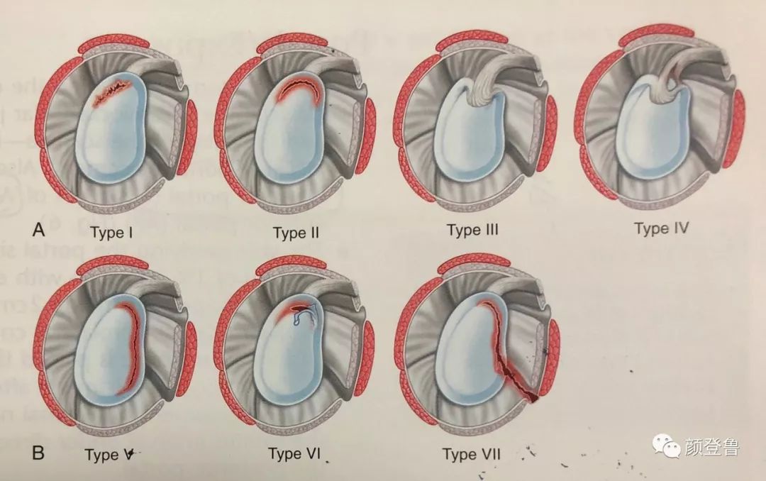 2,slap 损伤分为七型:上盂唇退变损伤,上盂唇撕裂分离,上盂唇桶柄样
