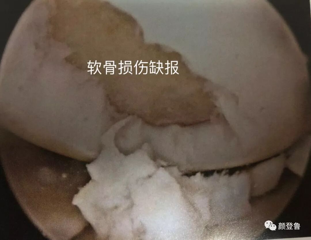 膝关节软骨损伤的诊断和治疗