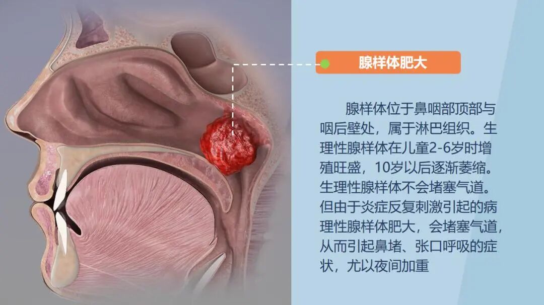 喉镜怎么不能无痛暑期科普系列（九）确诊腺样体肥大无痛快捷-电子鼻咽喉镜检查_https://www.jmylbn.com_新闻资讯_第3张