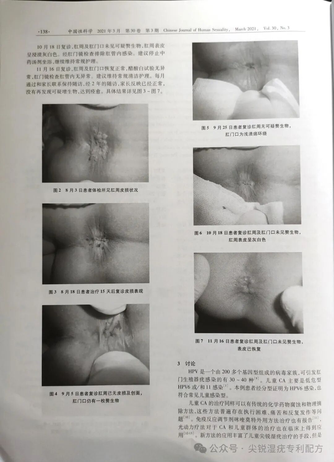 康复治疗激光怎么收费临床实录：夫妻尖锐湿疣康复案例（激光、药物治疗三次复发）_https://www.jmylbn.com_新闻资讯_第11张