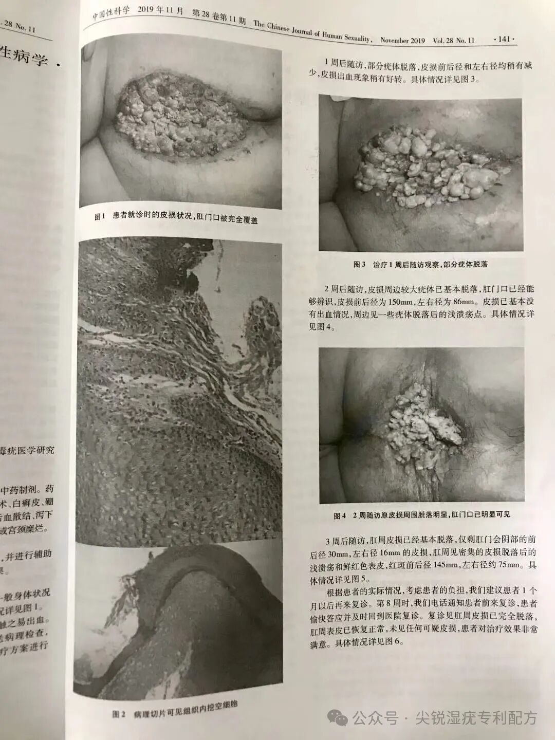 康复治疗激光怎么收费临床实录：女性外阴丶宫颈尖锐湿疣康复案例（激光、光动力治疗复发）_https://www.jmylbn.com_新闻资讯_第8张