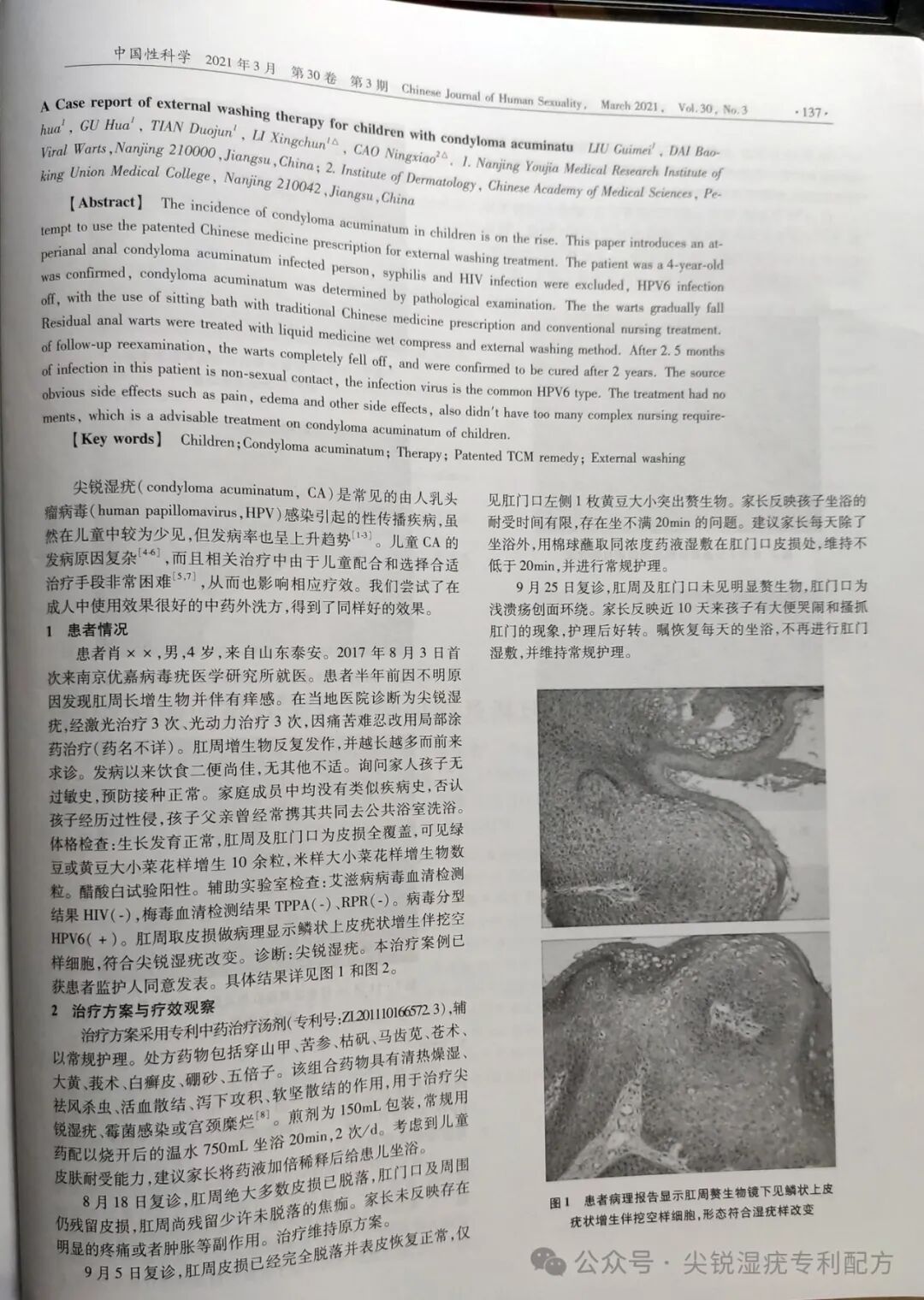 康复治疗激光怎么收费临床实录：夫妻尖锐湿疣康复案例（激光、药物治疗三次复发）_https://www.jmylbn.com_新闻资讯_第10张