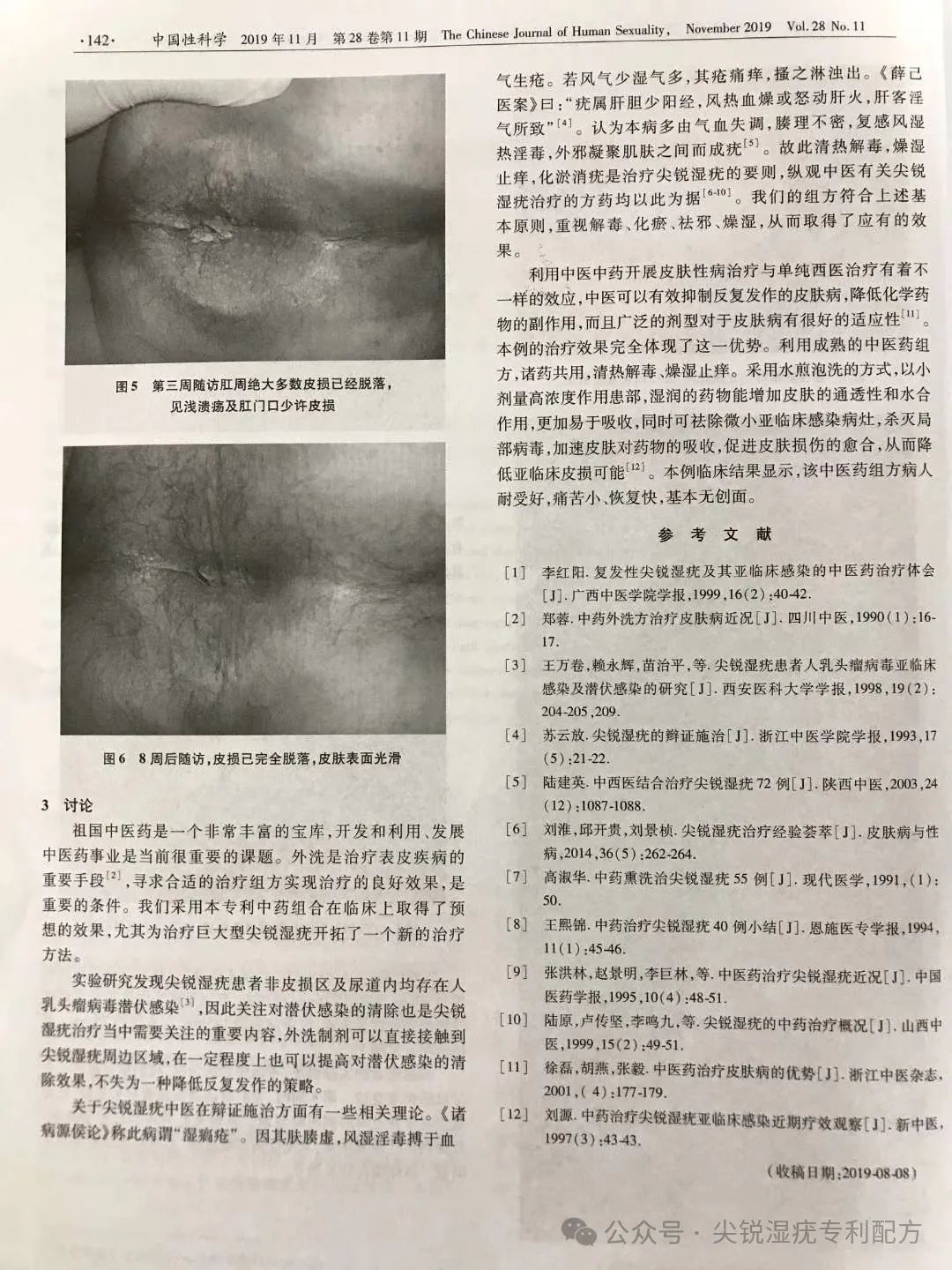 康复治疗激光怎么收费临床实录：女性外阴丶宫颈尖锐湿疣康复案例（激光、光动力治疗复发）_https://www.jmylbn.com_新闻资讯_第9张