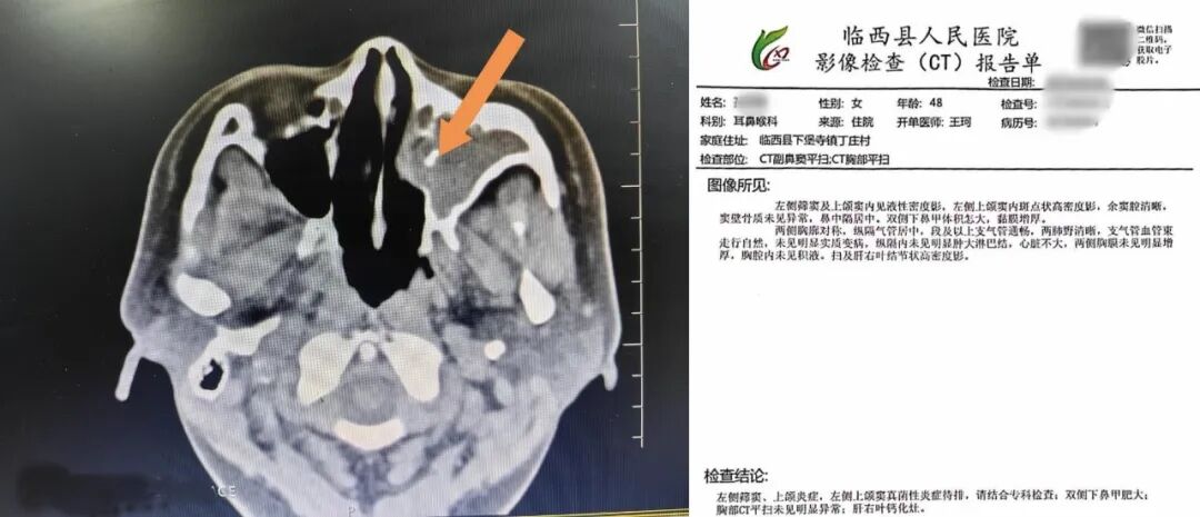 操作鼻窦镜时怎么摆小小鼻内镜解决真菌性鼻窦炎大问题_https://www.jmylbn.com_新闻资讯_第1张