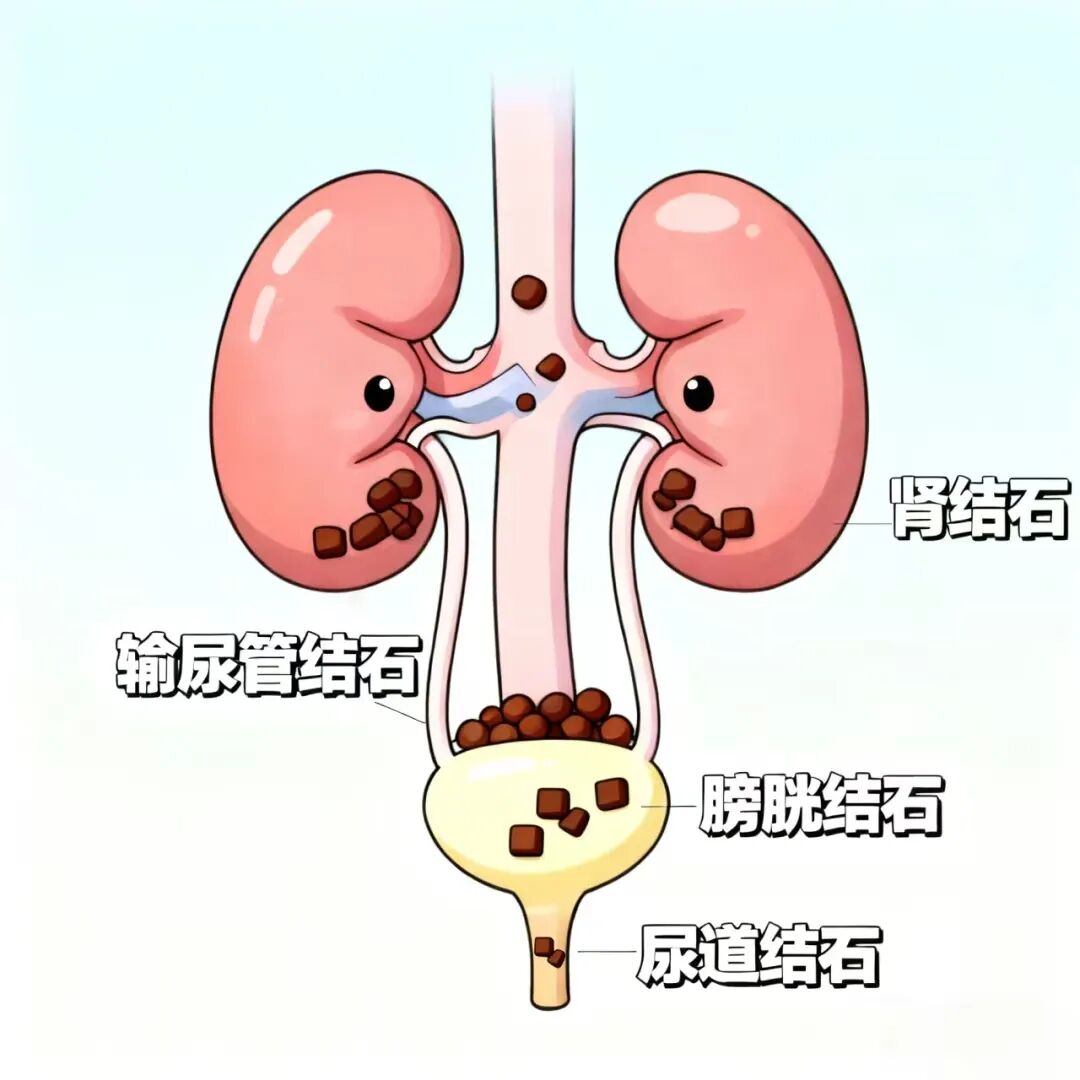 体外碎石b超怎么定位结石患者福音！德国多尼尔碎石机落户东部战区总医院_https://www.jmylbn.com_新闻资讯_第15张