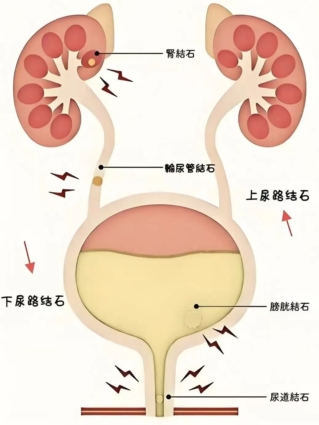体外碎石b超怎么定位结石患者福音！德国多尼尔碎石机落户东部战区总医院_https://www.jmylbn.com_新闻资讯_第12张