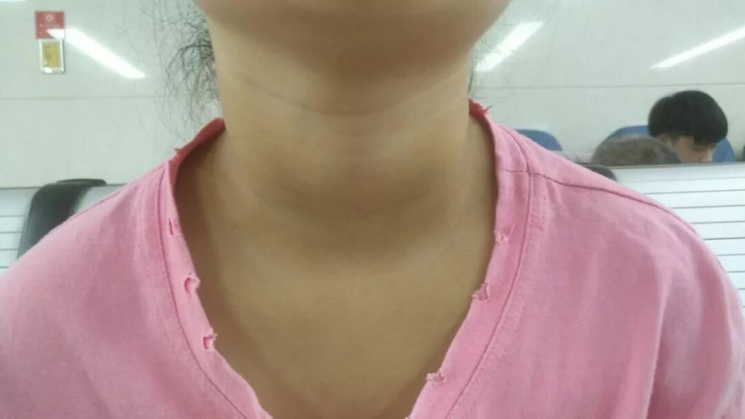 看看你家孩子有沒有脖子粗的情況 有了看看今天的文章 健康去哪了 微文庫