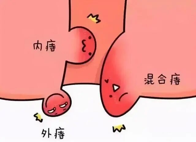 AED怎么自检女性做痔疮手术的危害？花一分钟自检一下,还是很准的!_https://www.jmylbn.com_新闻资讯_第1张