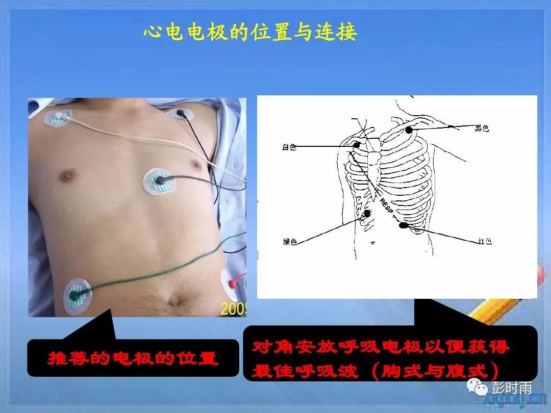 12导，18导联心电图，holter，心电监护上的导联你会安装吗？