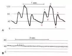 压力波是什么波正确认识动脉压力波形_https://www.jmylbn.com_新闻资讯_第8张