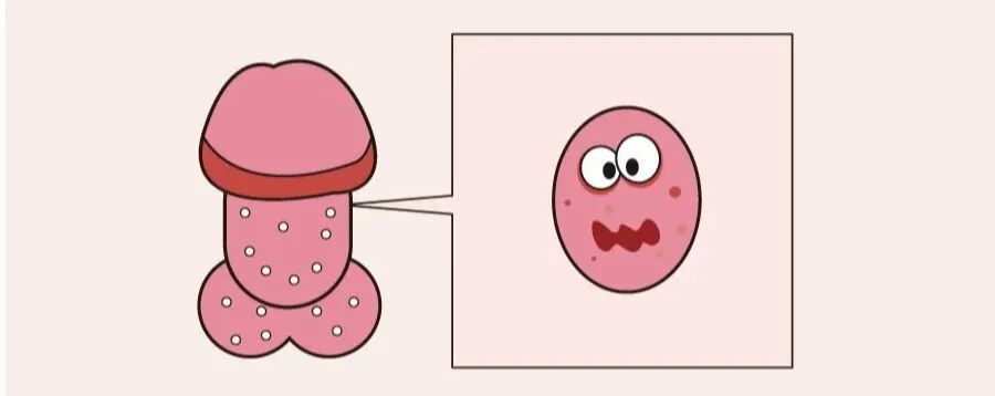 得了龟头炎不要忙着吃药,先弄清楚这6种类型!_邢台广慈医院