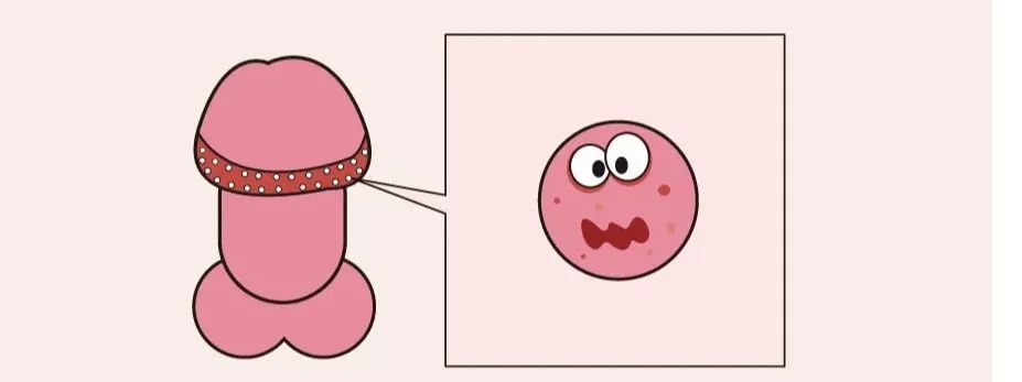 过长,慢性炎症刺激,以及跟你发育变异有一定的关系,主要表现为白色