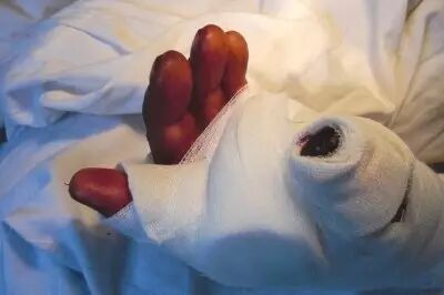 断指再植术后有哪些注意事项？术后疼痛怎么办？