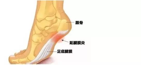 安全知识 走路像踩钉子 你的脚跟痛要这样康复 全球泛户外救援学院 微信公众号文章阅读 Wemp