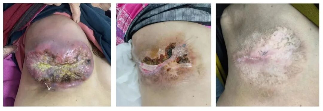 乳腺cr是什么【乳腺癌临床病例精选】伊尼妥单抗联合方案，治疗1例多线治疗后的局部晚期HER2阳性乳腺癌患者，取得接近CR效果_https://www.jmylbn.com_新闻资讯_第3张