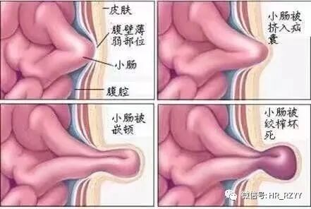 疝气补片怎么固定疝气“补丁” ｜ 腹腔镜下腹股沟疝修补术（TAPP）_https://www.jmylbn.com_新闻资讯_第6张