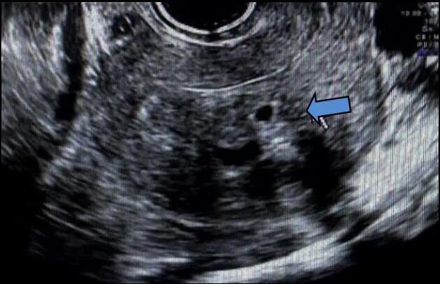 fh染色是什么意思妇瘤新视野丨FH缺陷型子宫平滑肌瘤 vs. 遗传性平滑肌瘤病和肾细胞癌综合征，附2则病例及文献复习_https://www.jmylbn.com_新闻资讯_第6张