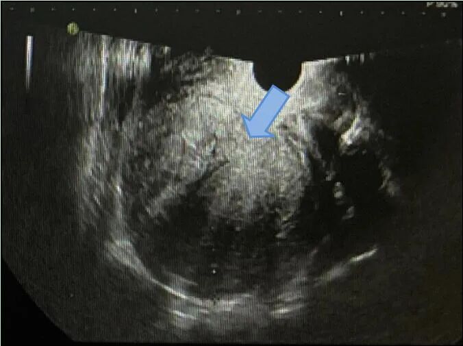 fh染色是什么意思妇瘤新视野丨FH缺陷型子宫平滑肌瘤 vs. 遗传性平滑肌瘤病和肾细胞癌综合征，附2则病例及文献复习_https://www.jmylbn.com_新闻资讯_第3张