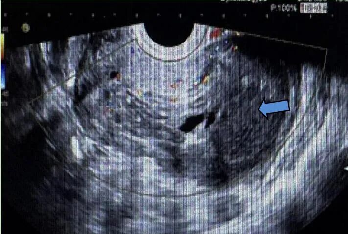 fh染色是什么意思妇瘤新视野丨FH缺陷型子宫平滑肌瘤 vs. 遗传性平滑肌瘤病和肾细胞癌综合征，附2则病例及文献复习_https://www.jmylbn.com_新闻资讯_第7张