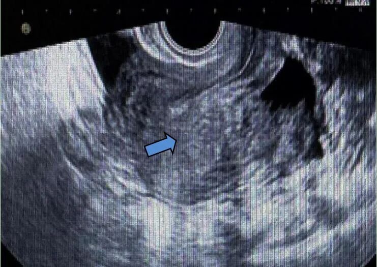 fh染色是什么意思妇瘤新视野丨FH缺陷型子宫平滑肌瘤 vs. 遗传性平滑肌瘤病和肾细胞癌综合征，附2则病例及文献复习_https://www.jmylbn.com_新闻资讯_第8张