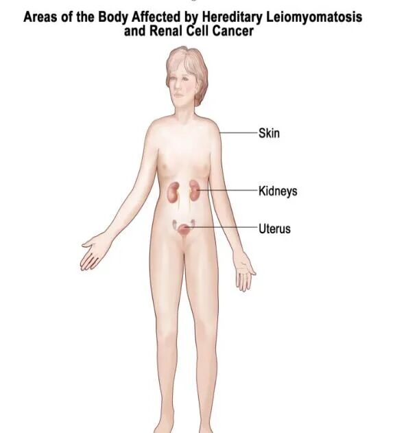 fh染色是什么意思妇瘤新视野丨FH缺陷型子宫平滑肌瘤 vs. 遗传性平滑肌瘤病和肾细胞癌综合征，附2则病例及文献复习_https://www.jmylbn.com_新闻资讯_第10张