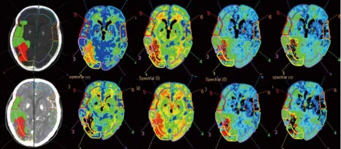 飞利浦ct有哪些型号浙江省首台飞利浦皓克Spectral 256排光谱CT落户丽水这家医院！_https://www.jmylbn.com_新闻资讯_第11张