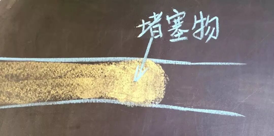 堵奶，到底是奶的问题，还是乳腺管的问题？