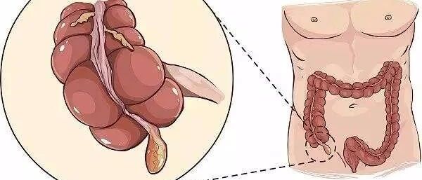 除了会发炎还会啥？阑尾：我还有你不知道的大用途！